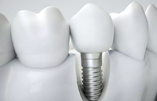 Model of dental implant